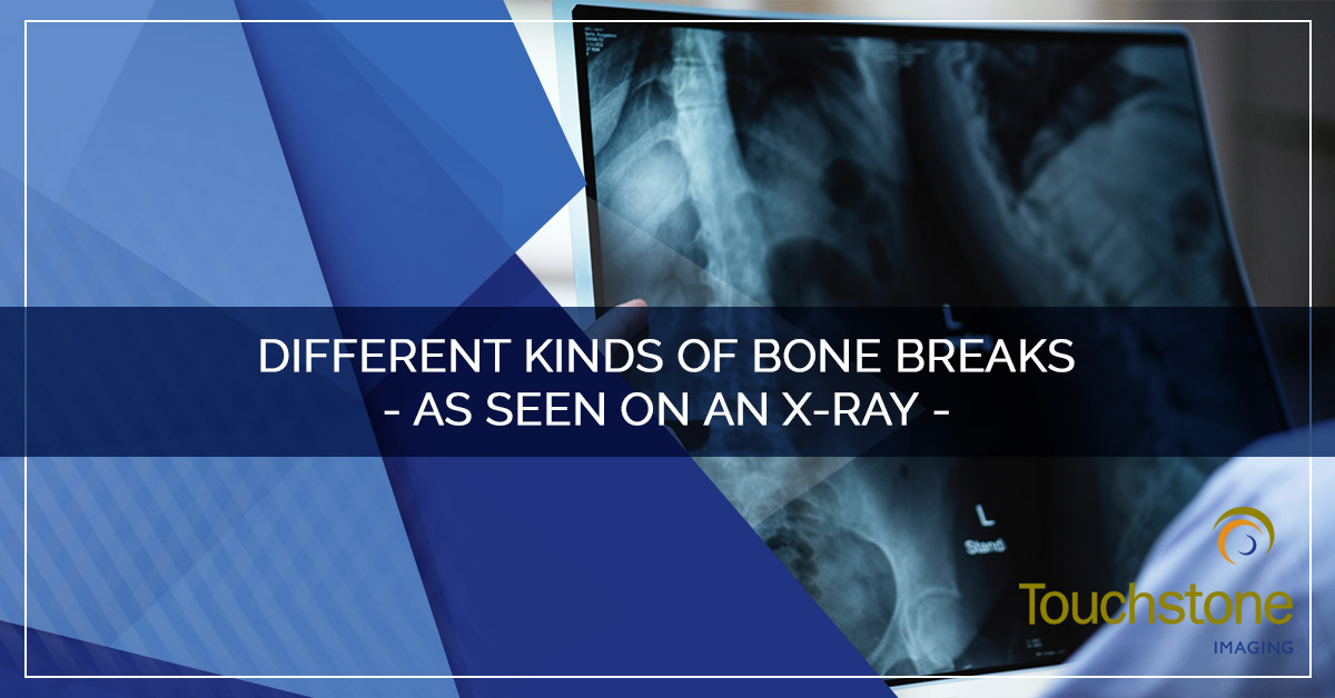 DIFFERENT KINDS OF BONE BREAKS – AS SEEN ON AN X-RAY