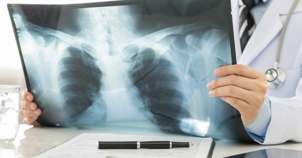 image of a man's hands holding an image of a chest x-ray