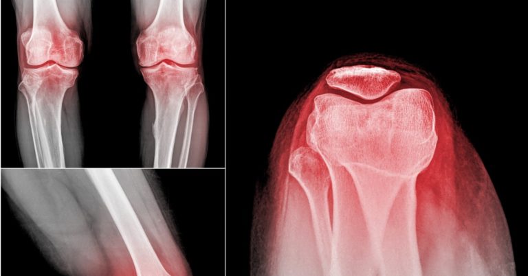 image of x-rays of a knee from 3 different angles