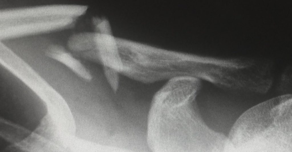 x-ray image of a broken clavicle