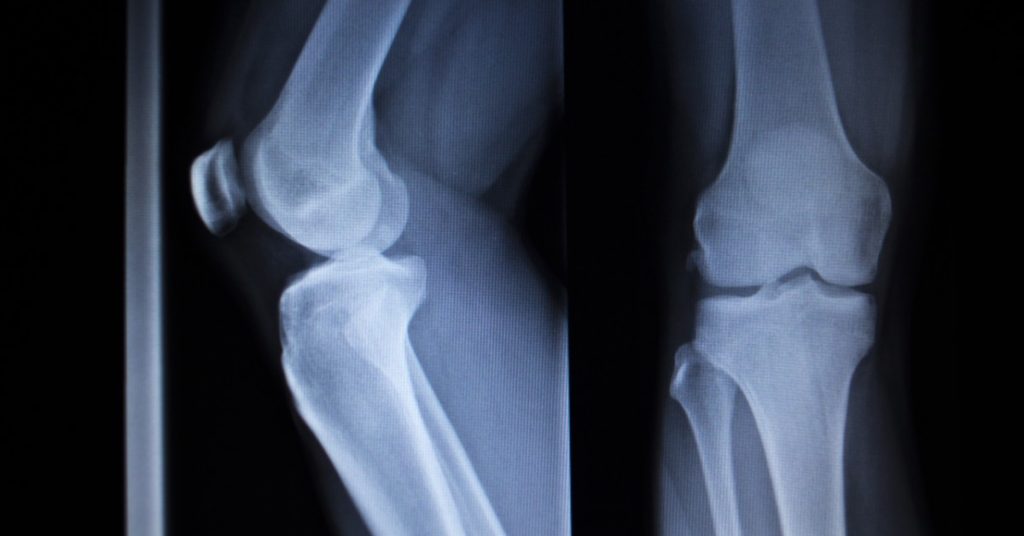 x-ray image if a knee