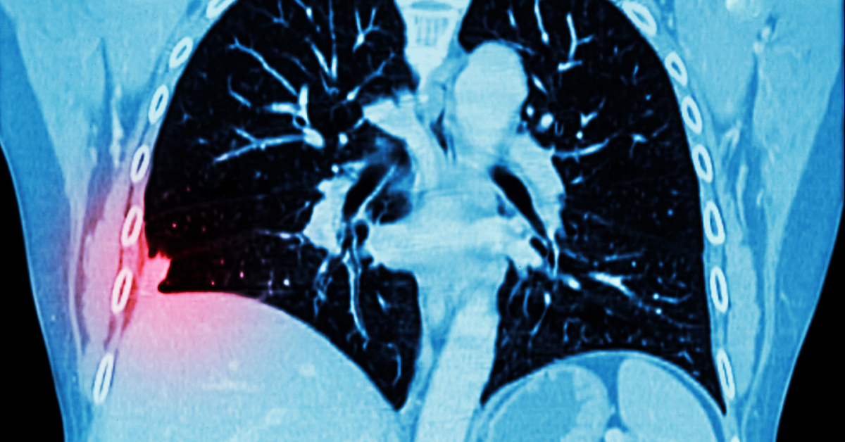 DO YOU NEED A LUNG CT SCAN FOR CANCER DETECTION?