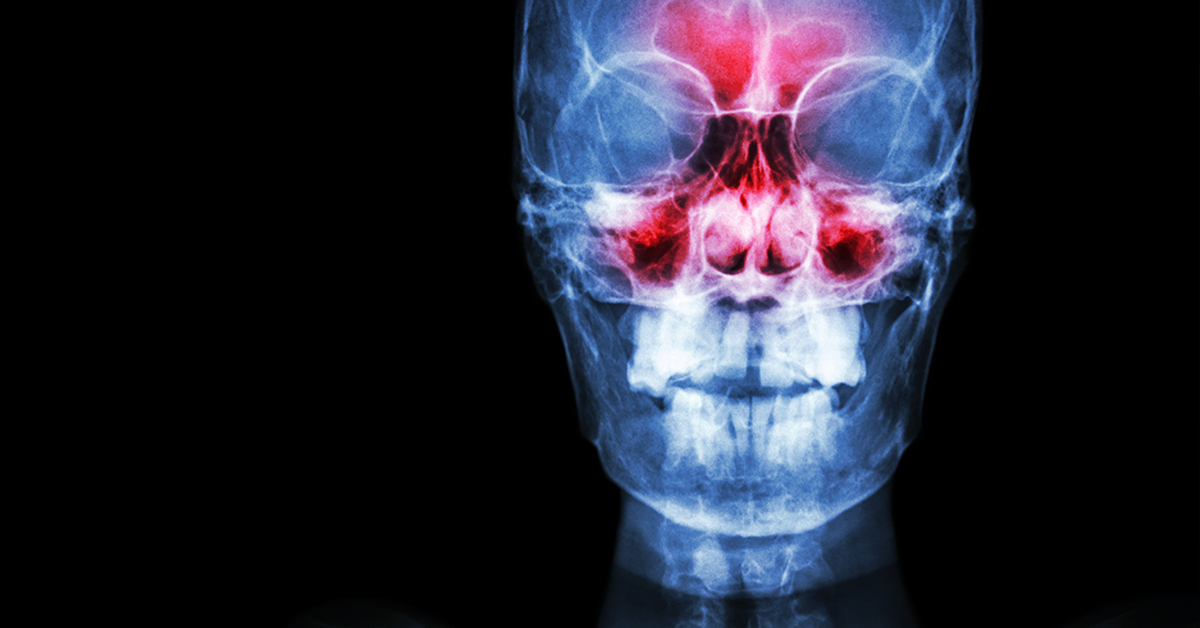 CT Scan Offers Better Sinusitis Treatment