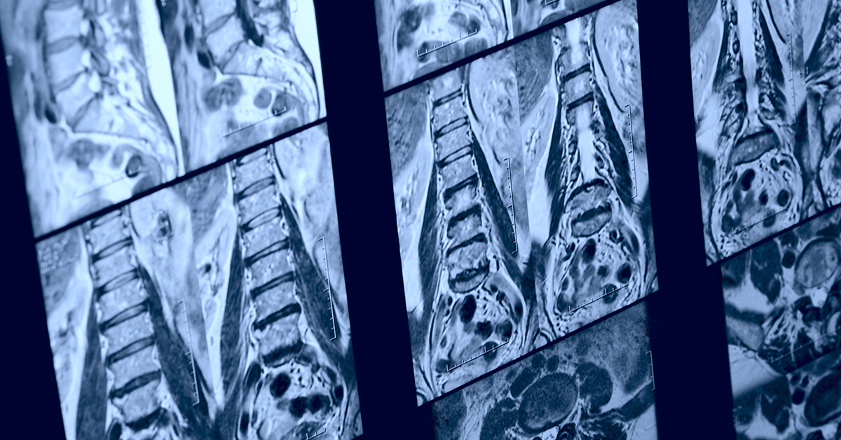 MRI for Back Pain—See What’s Inside