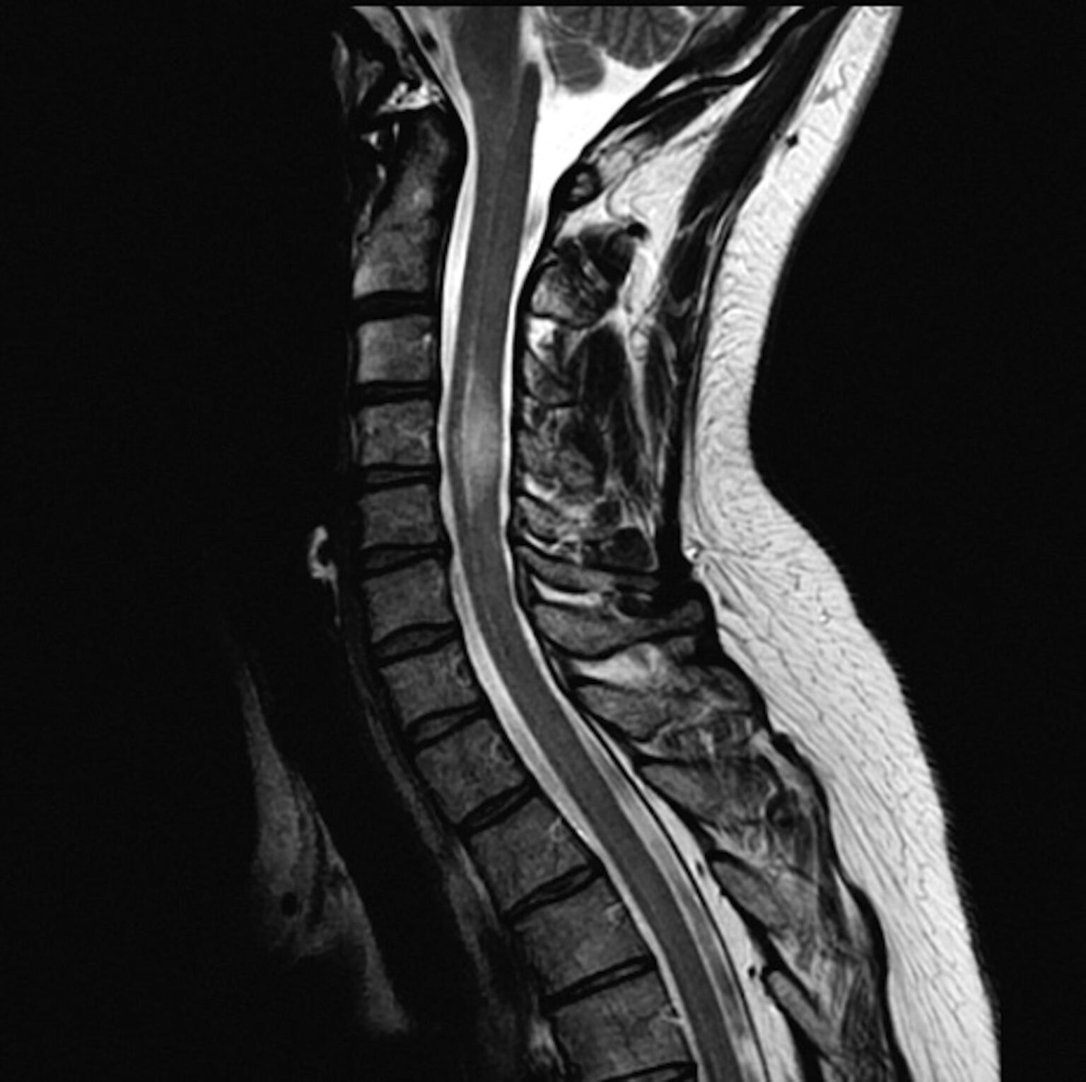 Myelogram Spinal Imaging • Touchstone Medical Imaging