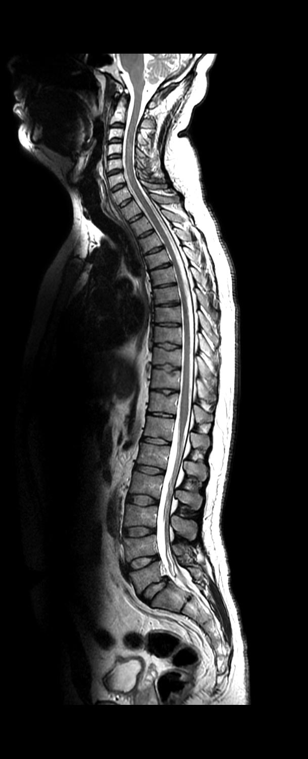 Arthrogram imaging of the full spine at touchstone medical imaging