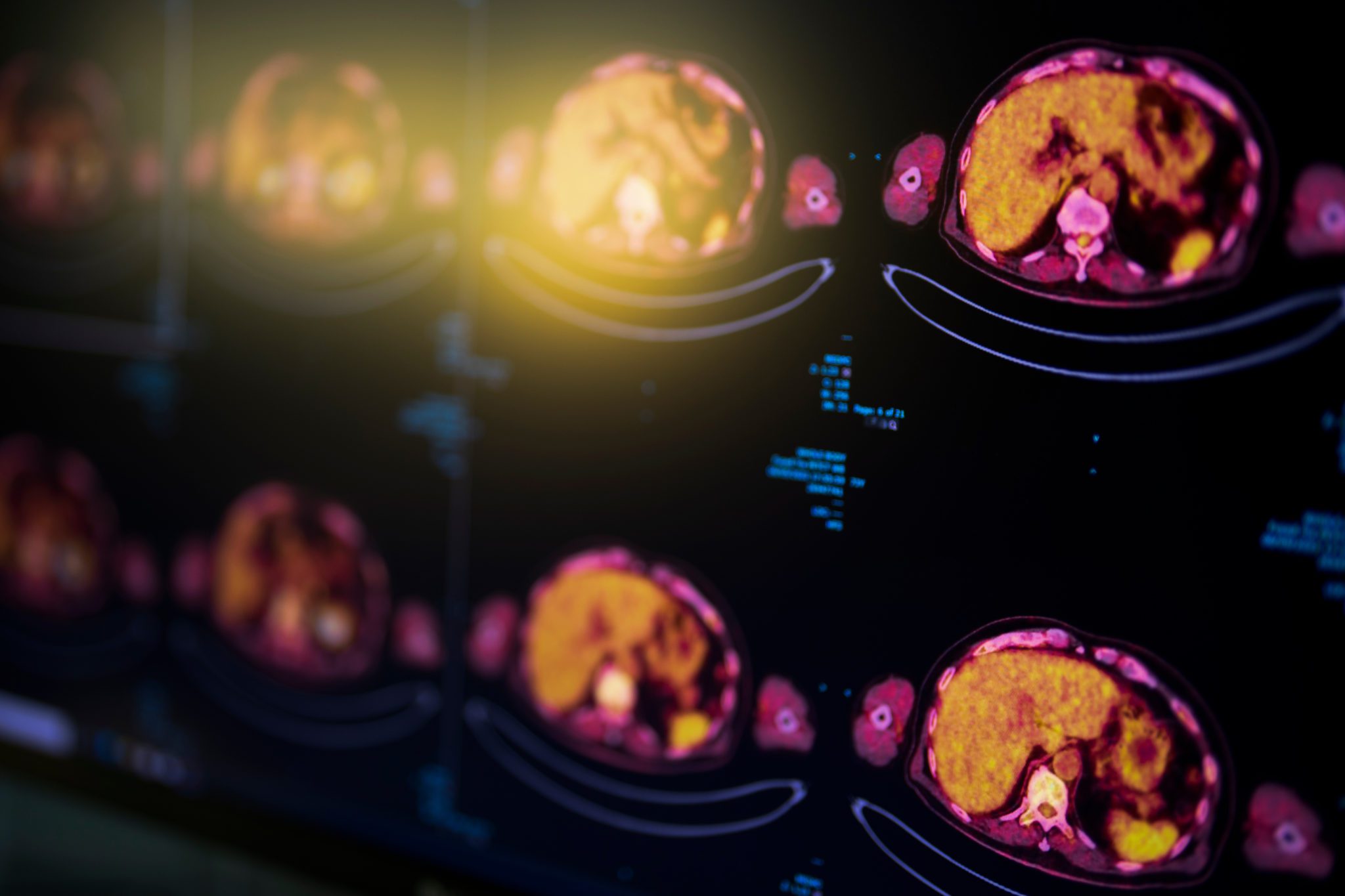 PET/CT • Touchstone Medical Imaging • Schedule Today