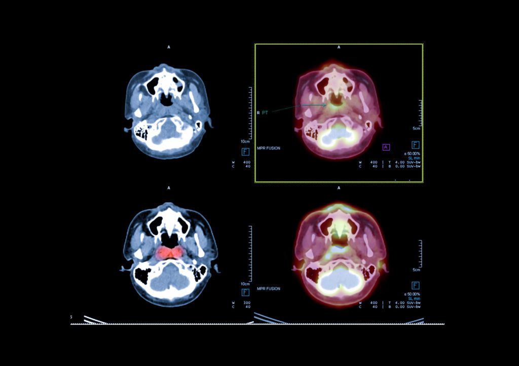 PET/CT • Touchstone Medical Imaging • Schedule Today