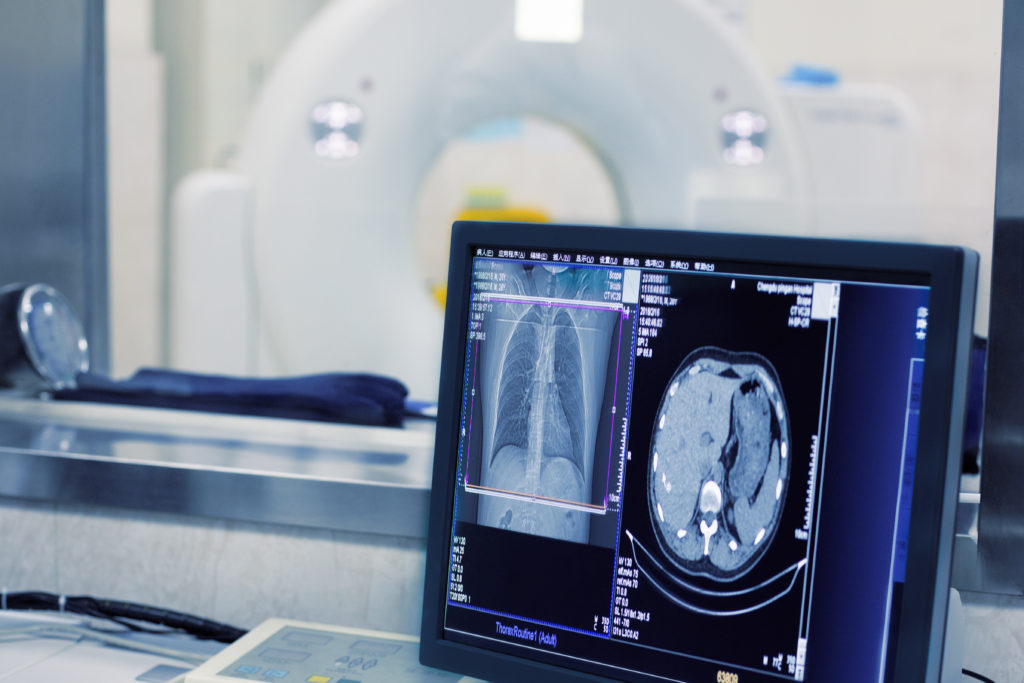 CT Scan for Chest and Lungs