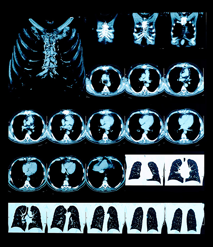 CT scan images of lungs
