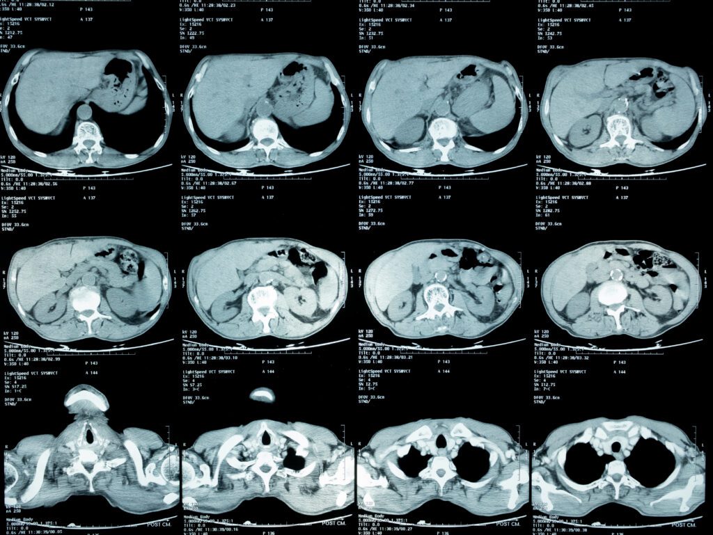Abdominal MRI imaging
