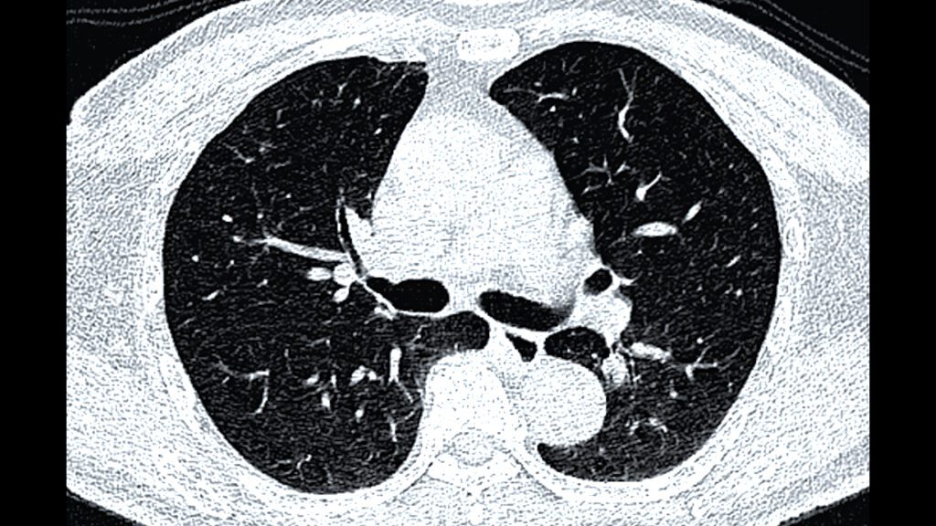 CT scan of Chest or lung axial view for screening lung nodules and lung cancer